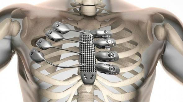 医生用3D打印为老人修关节 医生用3D打印为老人修关节